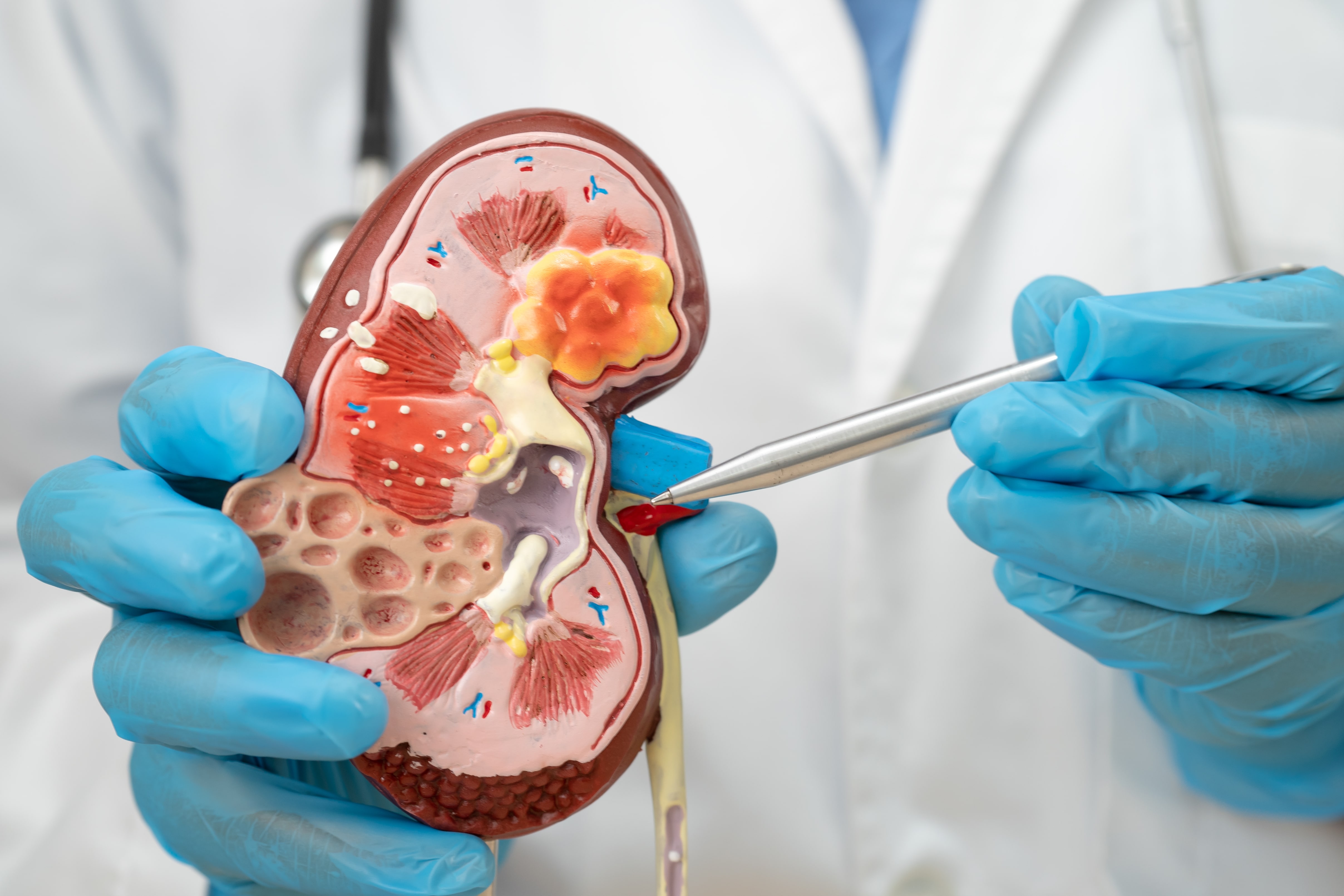 Peritonitis: Komplikasi Utama Dialisis Peritoneal dan Pencegahannya